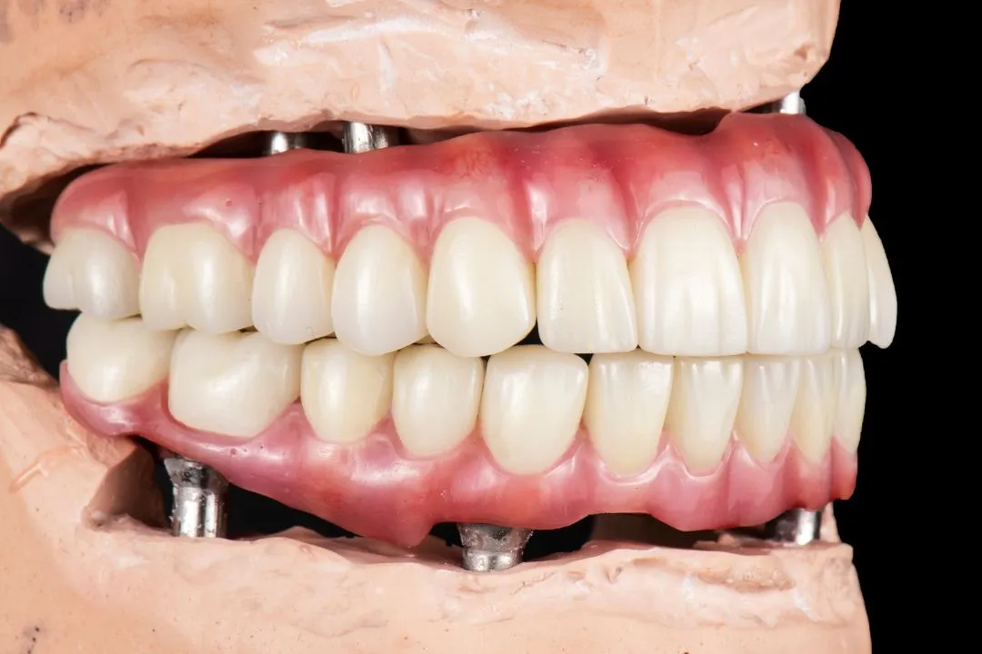 Unlocking Speech Clarity: The Impact of Dental Implants on Communication