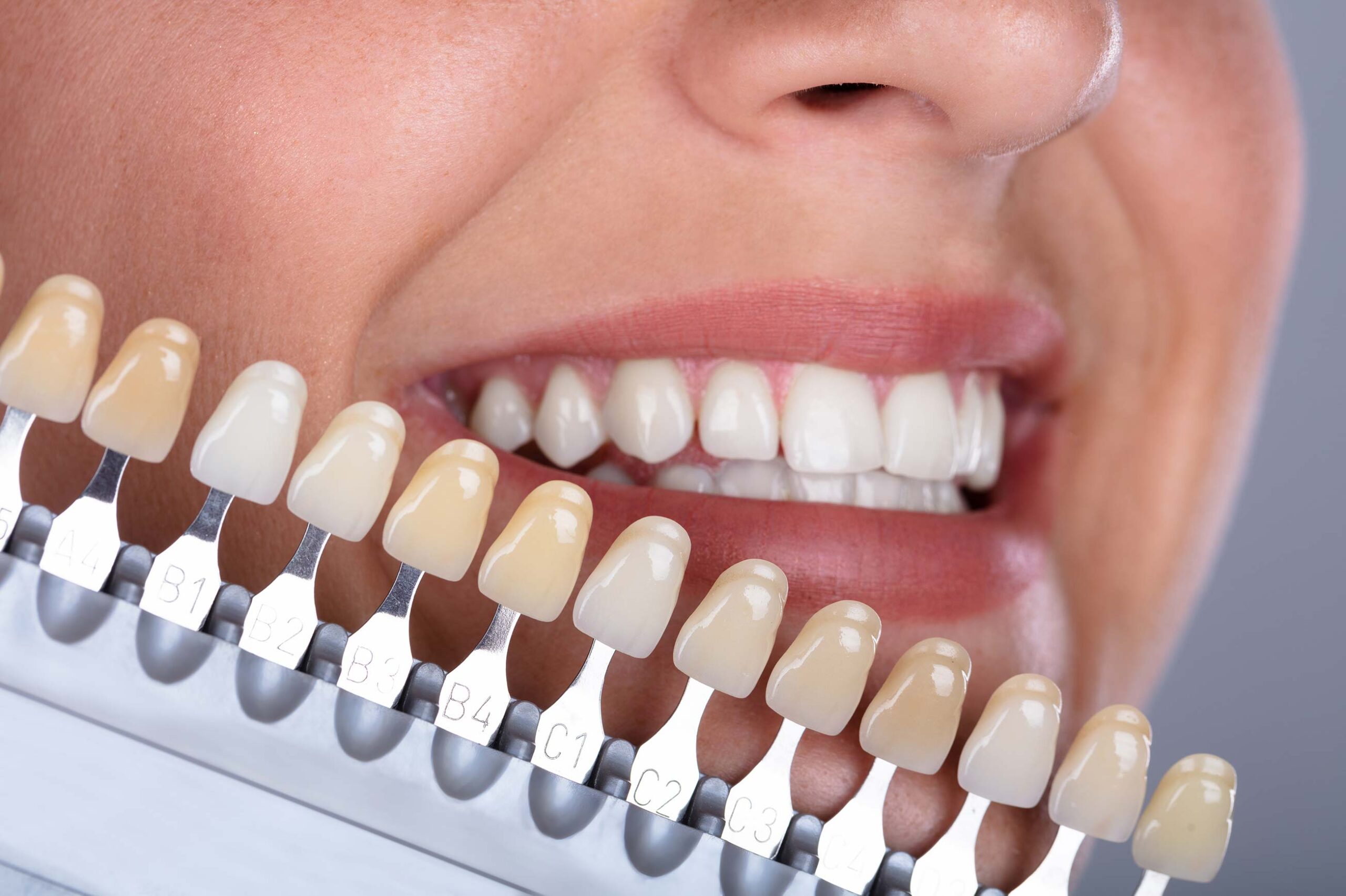 How Veneers Can Improve Light Reflection for a More Youthful Appearance
